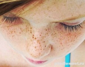 Типичное проявление веснушек на лице