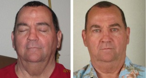 Фотография до и после удаления липомы на лбу