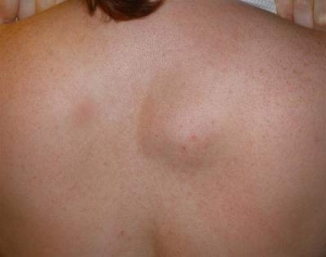 Фотография липомы на спине человека