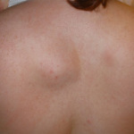 Типичная липома больших размеров