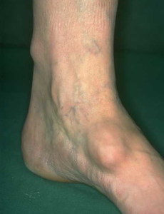 Фотография большой липомы