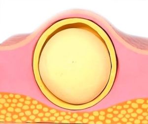 Схематичное представление подкожной липомы