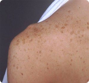 Фотография пигментных пятен, которые появились после посещения солярия