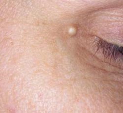 Фото липомы в области лица