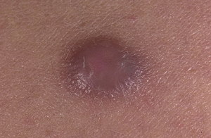 Фото дерматофибромы на коже руки