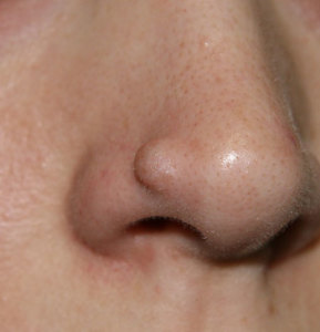 Типичное проявление фибромы