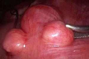 Фото фибромы на теле матки