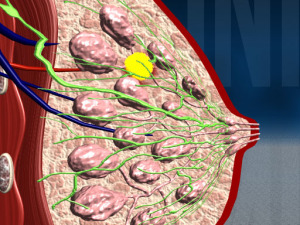 Схематичное фото фибромы в области молочной железы
