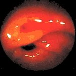 Кровотечение из сосудов желудка