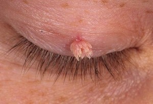 Остроконечные кондиломы