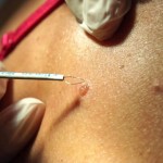 Процедура электрокоагуляции невуса