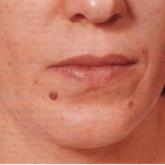 Невоклеточный невус (фото)