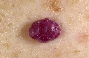 Новообразование на коже