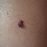 Кровенаполненная кондилома