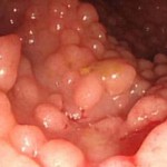 Диффузные полипы 