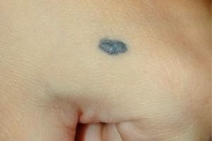 Фото 1 Голубой невус на руке