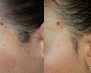 До и после удаления папилломатозного невуса