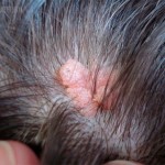 Папилломатозный невус