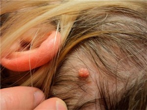 Папилломатозный невус