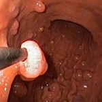 Удаление полипа с помощью лазера