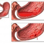 Желудочное кровотечение Желудочное кровотечение