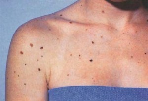 Диспластический невус на коже