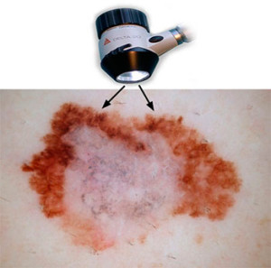 Лазерное удаление невуса