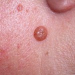 Диспластический невус
