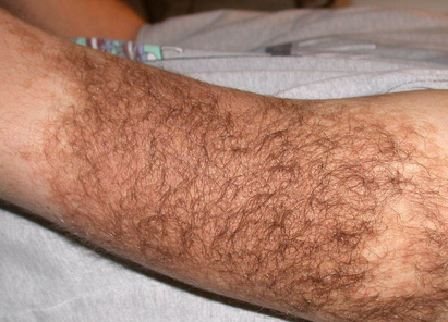 Волосяной невус Беккера