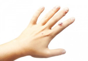 Папиллома наруке