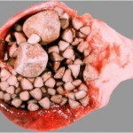 Камни в желчном пузыре Камни в желчном пузыре