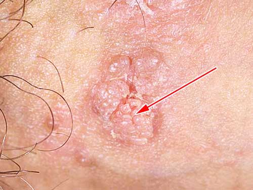 Внешний вид остроконечной кондиломы