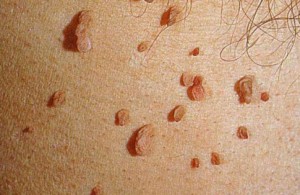 Папилломы на коже