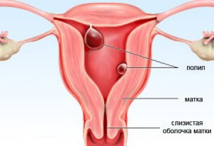 Приклрепление полипов к шейке матки