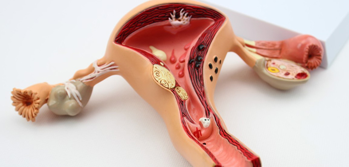 Внешний вид полипов в матке Внешний вид полипов в матке