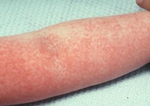 Аллергическая реакция в виде выпи