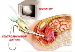 Вагинальное УЗИ для уточнения диагноза
