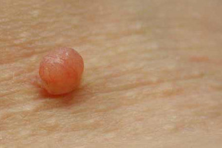 Внешний вид бородавки Внешний вид бородавки