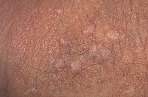 Бородавки в интимной зоне у мужчин