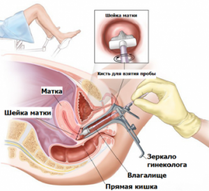 Взятие мазка с шейки матки на цитологию