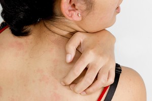 Аллергия на препарат