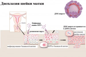 Дисплазия шейки матки