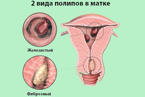 Два вида полипов в матке Два вида полипов в матке