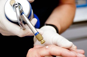 Криодеструкция папилломы