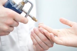 Криодеструкция папилломы