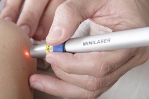 Лазерное удаление папилломы