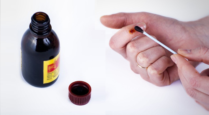 Лечение папиллом йодом