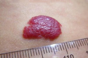 Образование гемангиомы