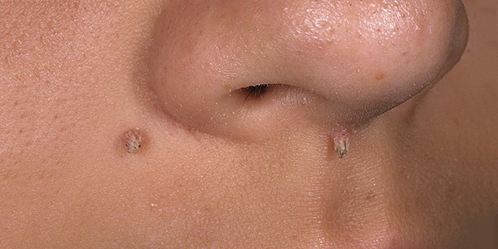 Папилломы на лице Папилломы на лице