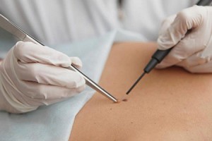 Удаление папилломы в клинике